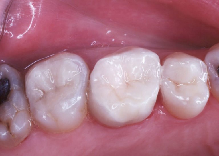 White Fillings Hazeldean Family Dental
